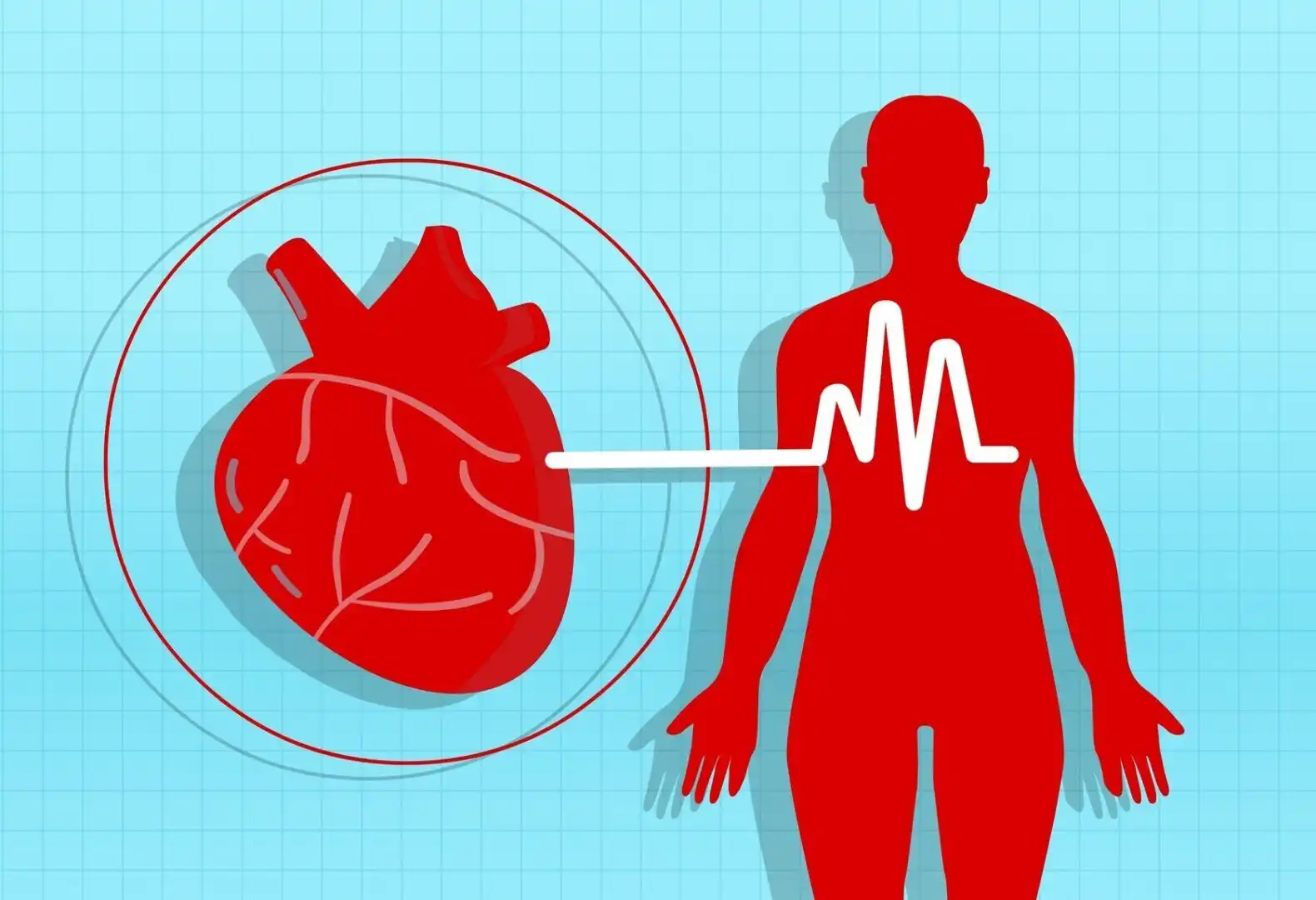 Ilustración comparativa de una arteria saludable y una arteria con hipertensión